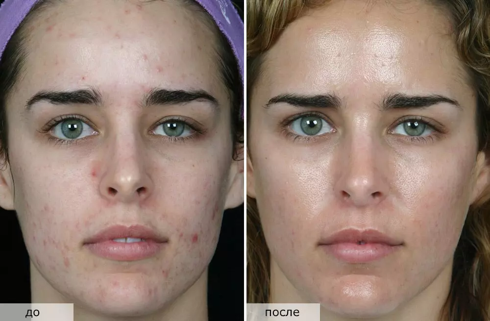 Чистка лица у косметолога: до и после