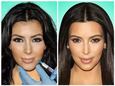 Ким Кардашьян: фото до и после пластики