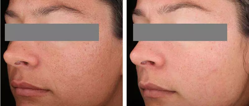 Чистка лица у косметолога: до и после
