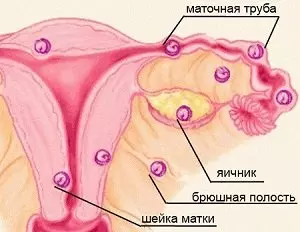 Внематочная беременность на ранних сроках