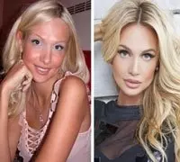 Виктория Лопырева фото до и после пластики