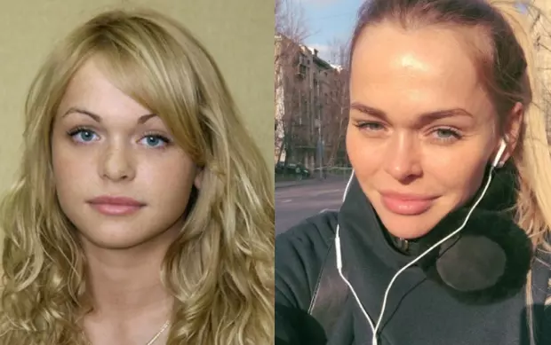 Анна Хилькевич до и после пластики – как изменилась звезда после пластических операций